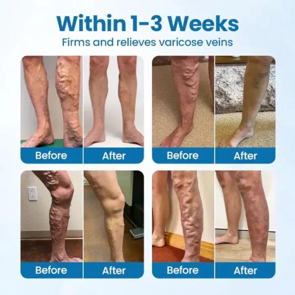 🦵Ourlyard® Herbal Leg Spray