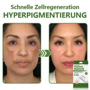 Ourlyard® Magnesium MicroNeedle Schnell Entfernen Hautmal-Pflaster