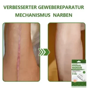 Ourlyard® Magnesium MicroNeedle Schnell Entfernen Hautmal-Pflaster