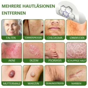 Ourlyard® Magnesium MicroNeedle Schnell Entfernen Hautmal-Pflaster