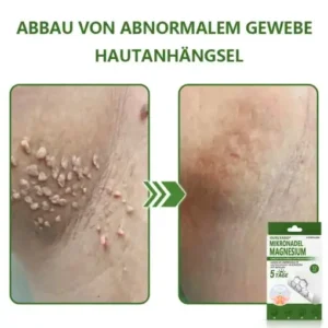 Ourlyard® Magnesium MicroNeedle Schnell Entfernen Hautmal-Pflaster