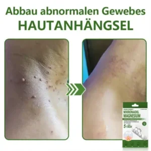 Ourlyard® Magnesium MicroNeedle Schnell Entfernen Hautmal-Pflaster