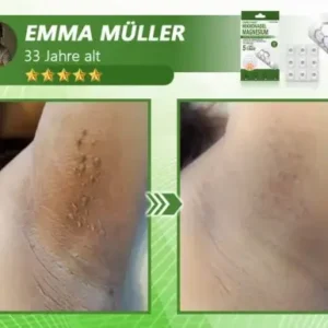 Ourlyard® Magnesium MicroNeedle Schnell Entfernen Hautmal-Pflaster