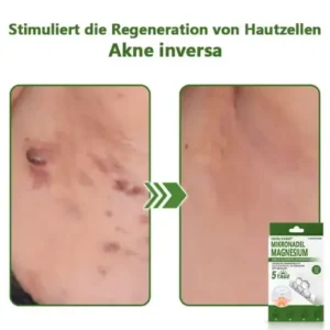 Ourlyard® Magnesium MicroNeedle Schnell Entfernen Hautmal-Pflaster