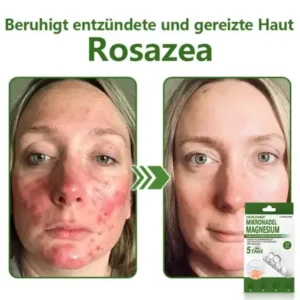 Ourlyard® Magnesium MicroNeedle Schnell Entfernen Hautmal-Pflaster