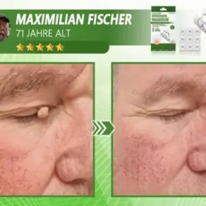 Ourlyard® Magnesium MicroNeedle Schnell Entfernen Hautmal-Pflaster