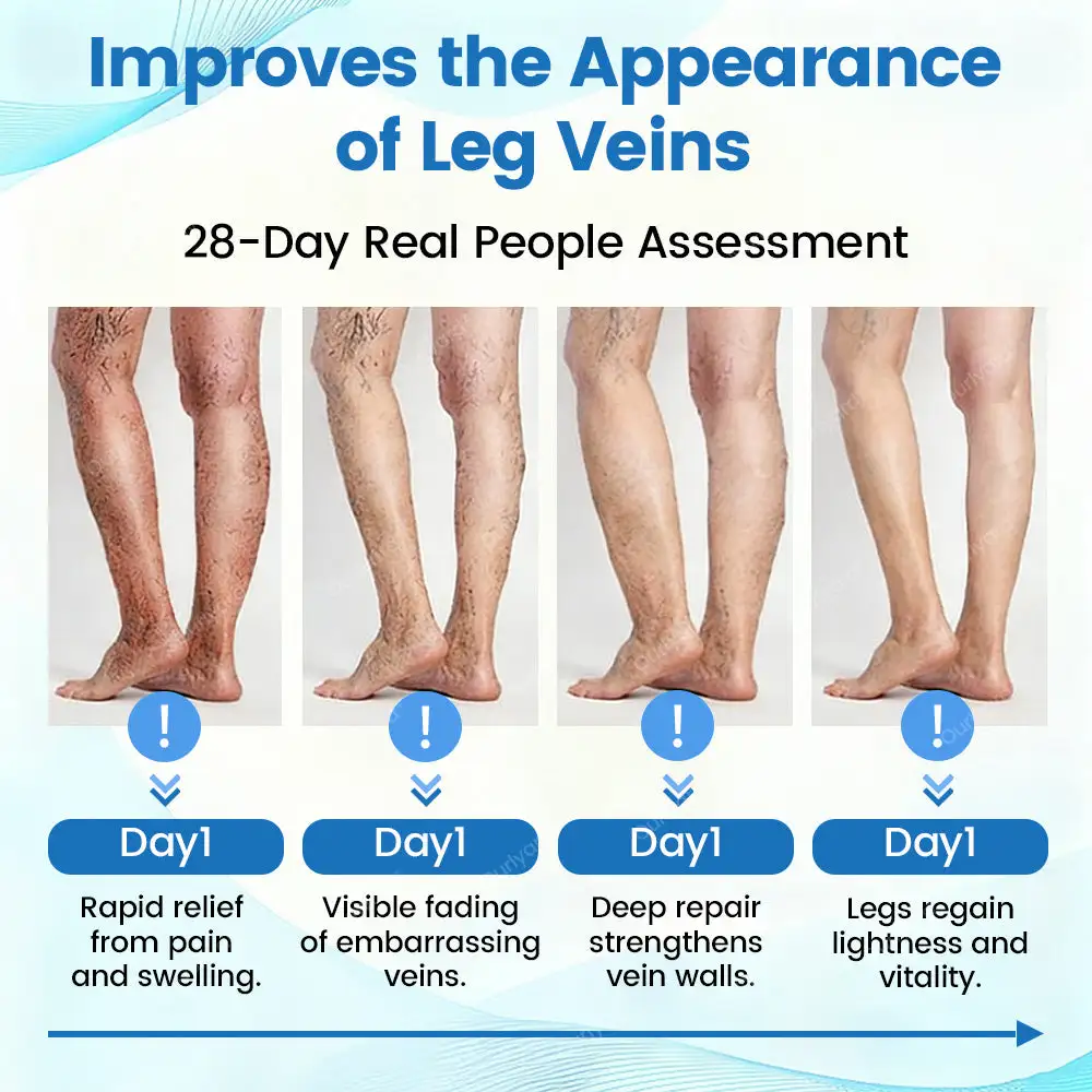 ✨Ourlyard® VascuCare Vein Healing Spray(Designed for Varicose veins, Spider veins, Deep vein Thrombosis, Chronic venous insufficiency, Venous ulcers, Thrombophlebitis and other venous issues)