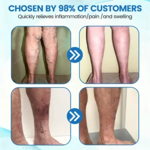 ✨Ourlyard® VascuCare Vein Healing Spray(Designed for Varicose veins, Spider veins, Deep vein Thrombosis, Chronic venous insufficiency, Venous ulcers, Thrombophlebitis and other venous issues)