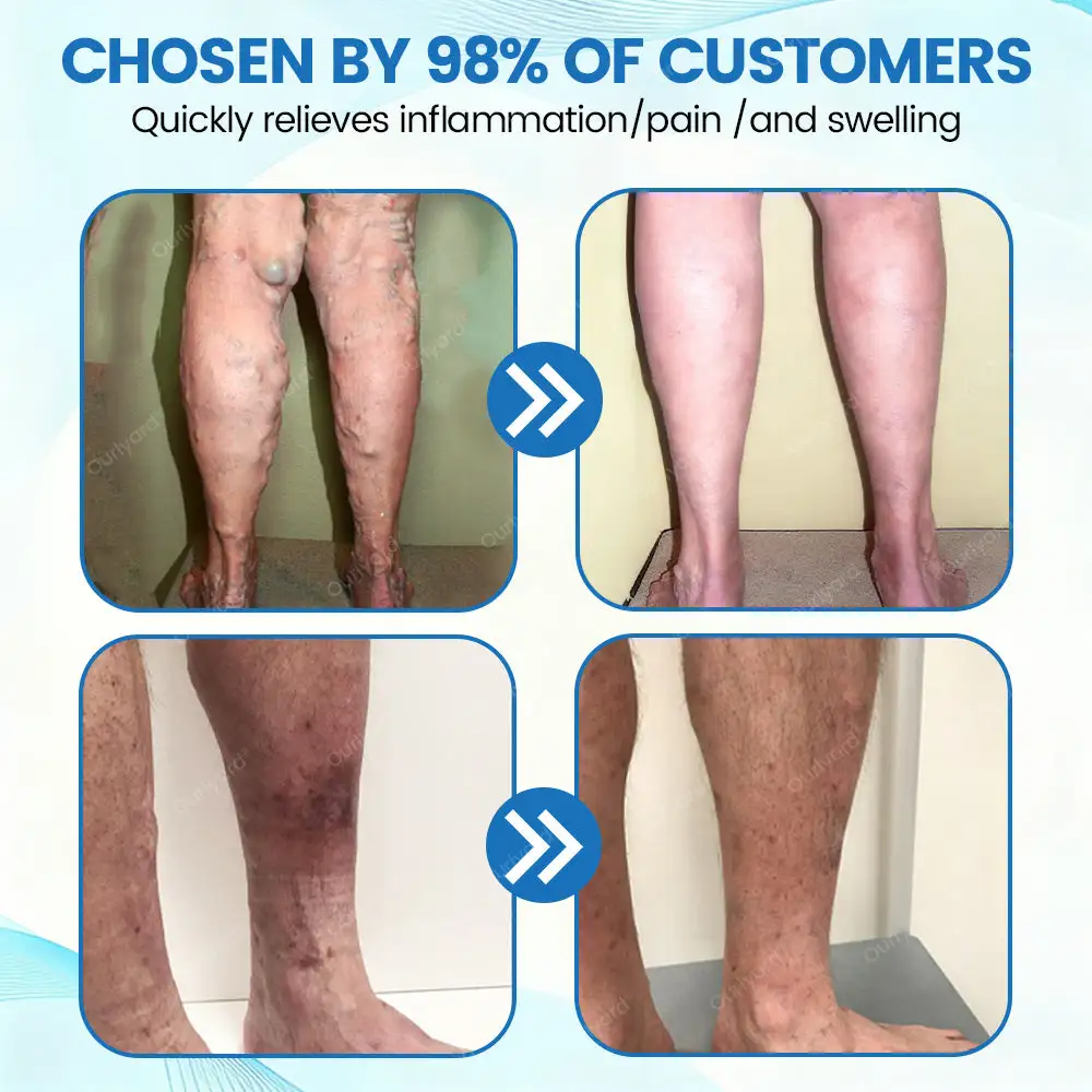 ✨Ourlyard® VascuCare Vein Healing Spray(Designed for Varicose veins, Spider veins, Deep vein Thrombosis, Chronic venous insufficiency, Venous ulcers, Thrombophlebitis and other venous issues)