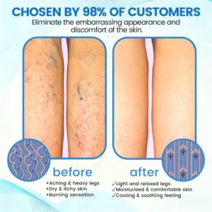 ✨Ourlyard® VascuCare Vein Healing Spray(Designed for Varicose veins, Spider veins, Deep vein Thrombosis, Chronic venous insufficiency, Venous ulcers, Thrombophlebitis and other venous issues)