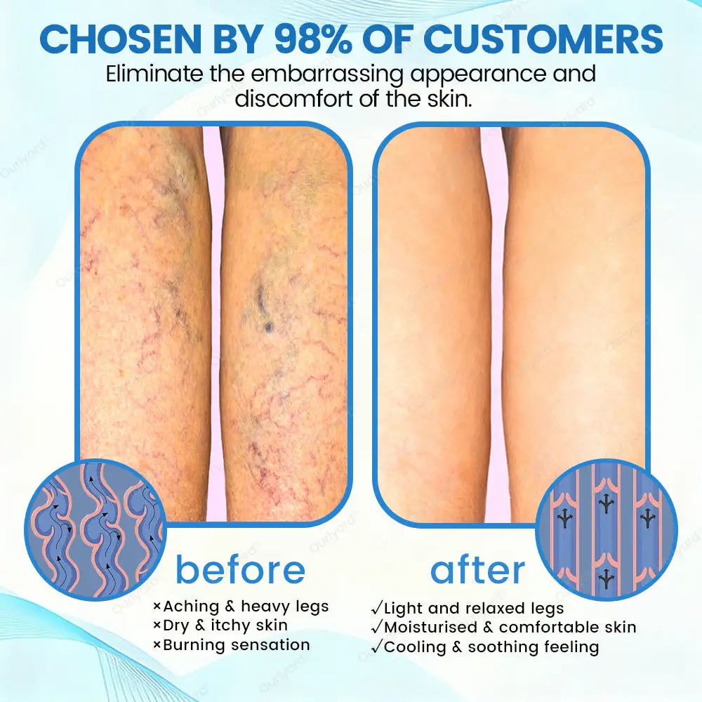 ✨Ourlyard® VascuCare Vein Healing Spray(Designed for Varicose veins, Spider veins, Deep vein Thrombosis, Chronic venous insufficiency, Venous ulcers, Thrombophlebitis and other venous issues)
